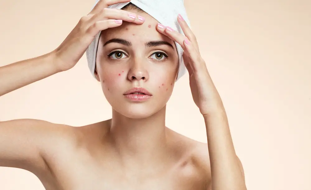 The Ingredients You Should Look For While Buying Acne Treating Products
