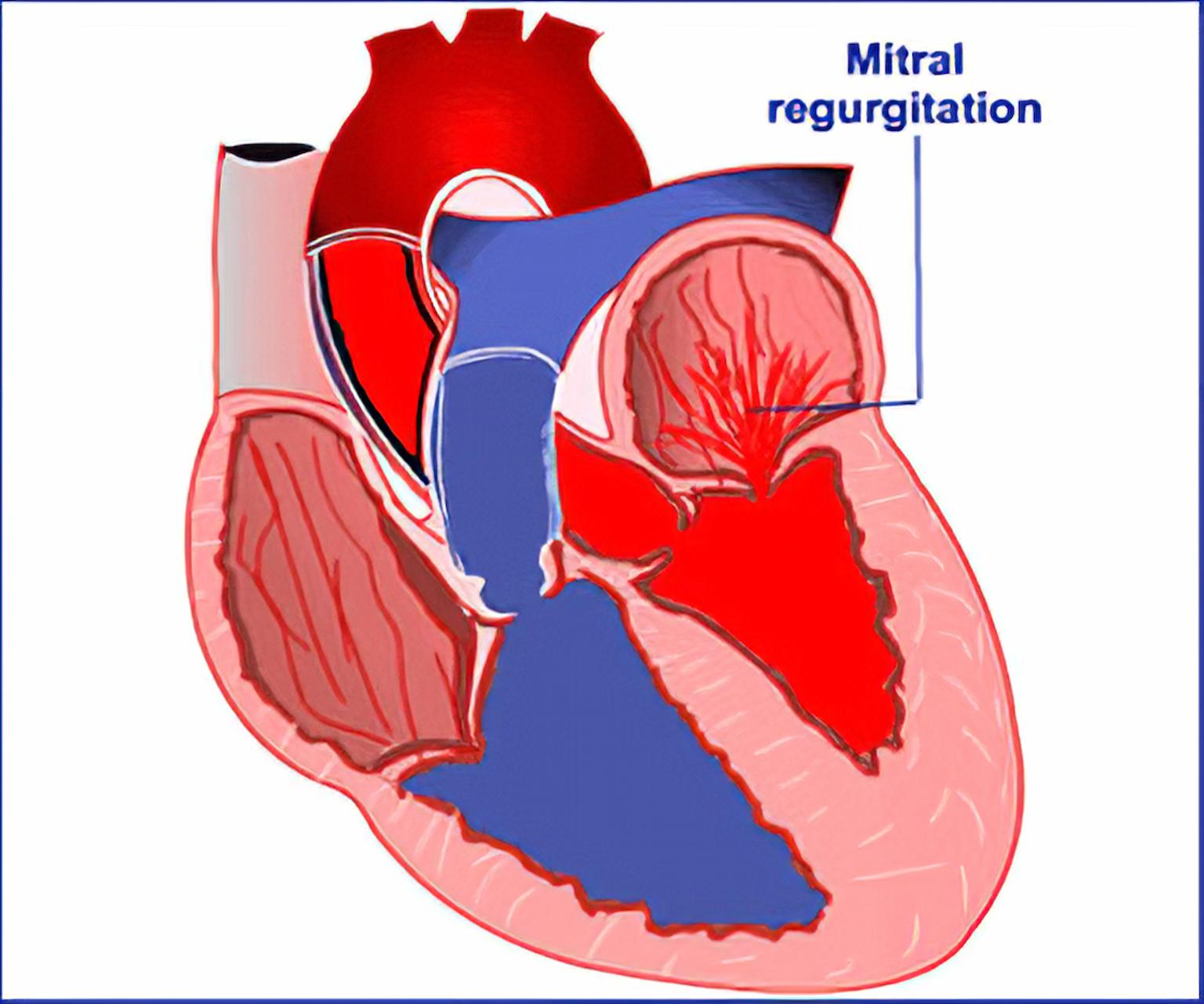 What Is Mitral Regurgitation? – Everything You Need To Know!
