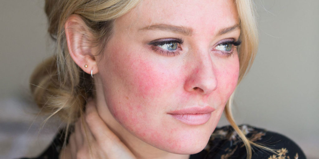 Rosacea-Condition