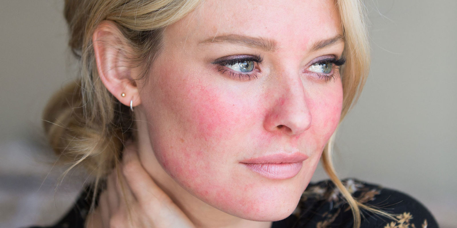 How Can Rosacea-Condition Be Well-Treated By Chemical Peels?