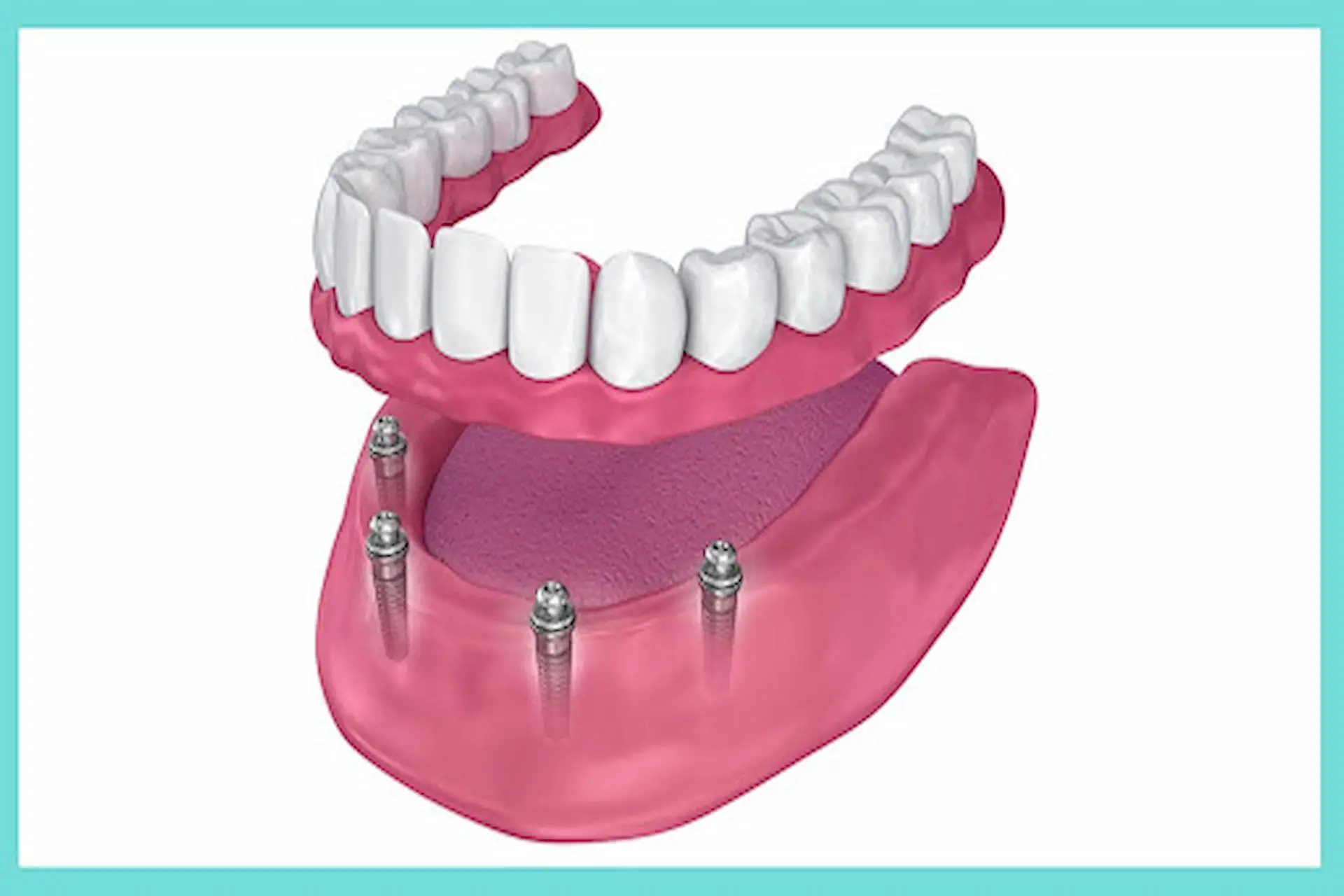 Dental Implants And How Do They Work? A Comprehensive Overview