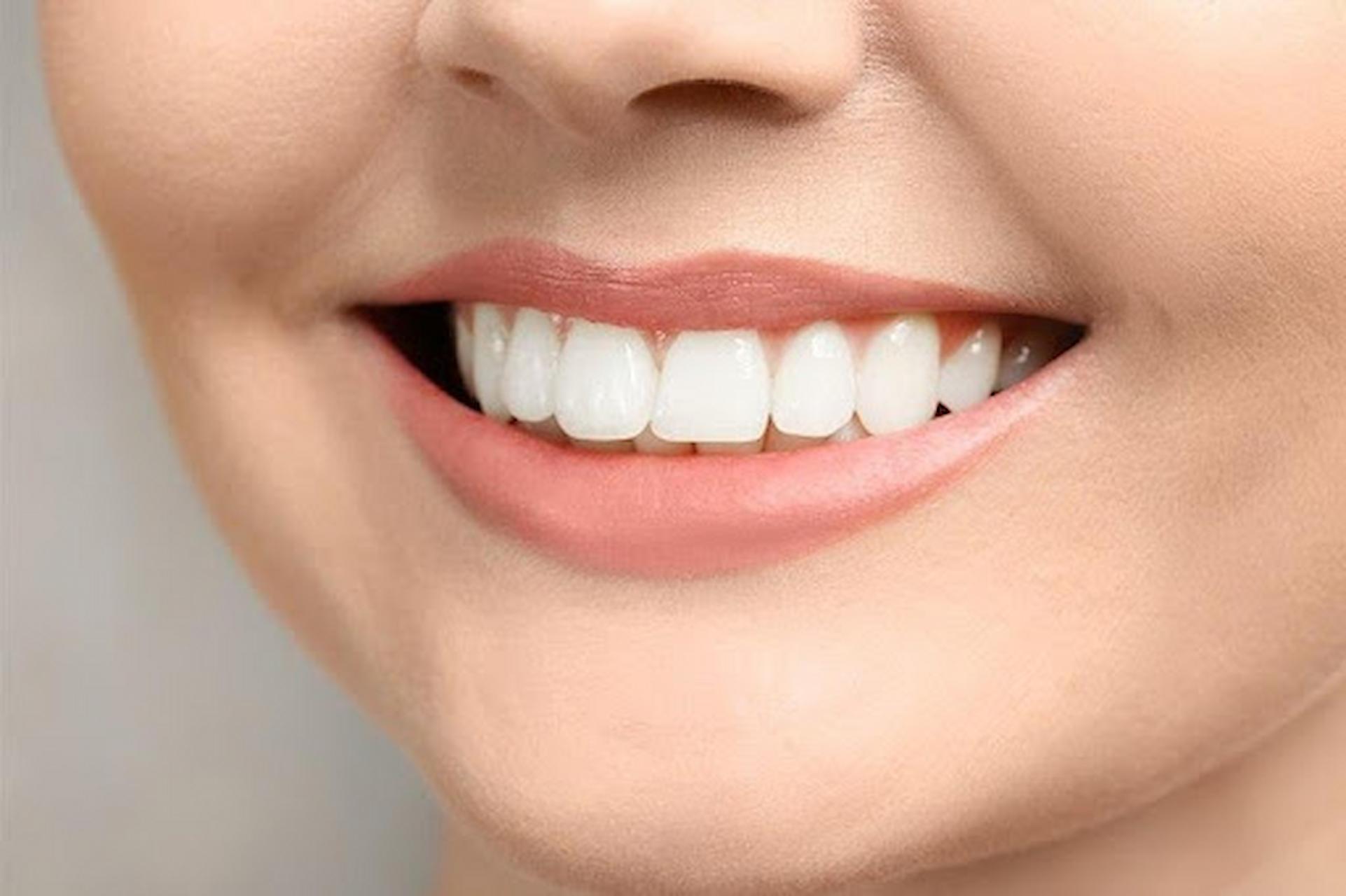 How You Can Help Minimize The Cost Of Dental Veneers